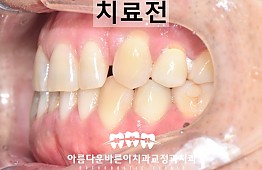 수술전