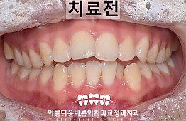 수술전