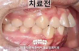 수술전