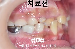 수술전