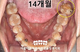 수술후