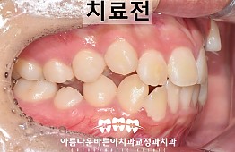 수술전