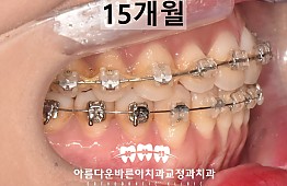 수술후