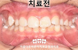 수술전