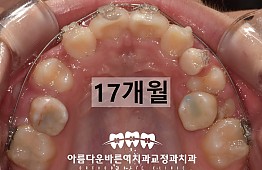 수술후