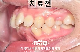 수술전