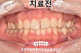 수술전