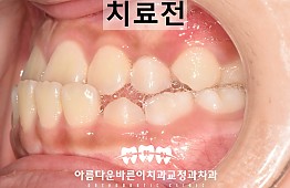 수술전