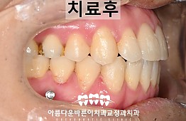 수술후