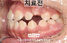 수술전
