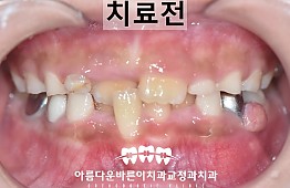 수술전