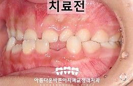 수술전