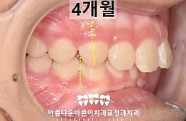 수술후