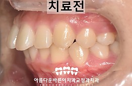 수술전