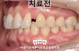 수술전