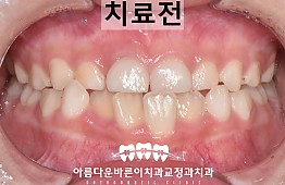 수술전