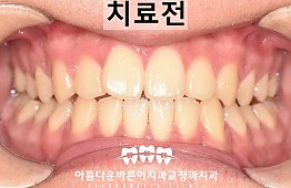 수술전