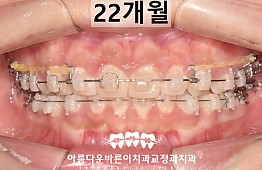 수술후