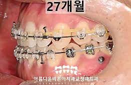 수술후