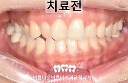 수술전