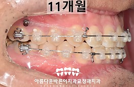 수술후