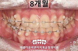 수술후