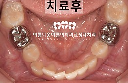 수술후