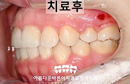 수술후