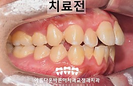 수술전