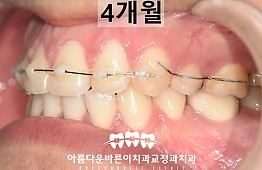 수술후