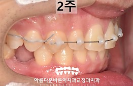 수술후