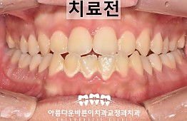 수술전