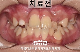 수술전
