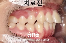 수술전