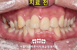 수술전