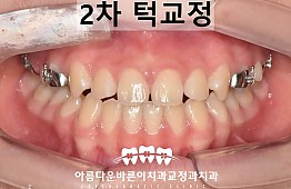 수술후