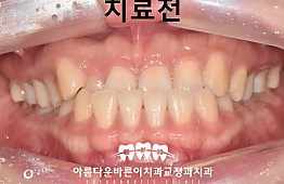 수술전