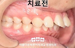 수술전