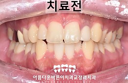 수술전