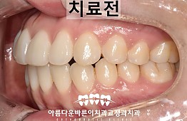 수술전