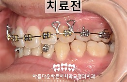 수술전