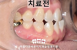 수술전