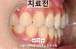 수술전