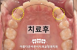 수술후