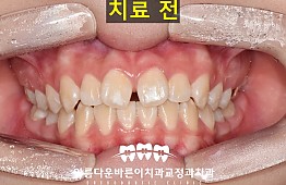 수술전