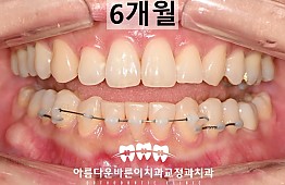수술후