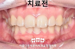 수술전