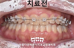 수술전