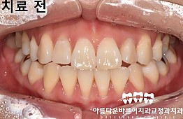 수술전