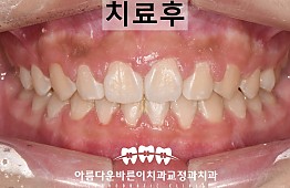 수술후